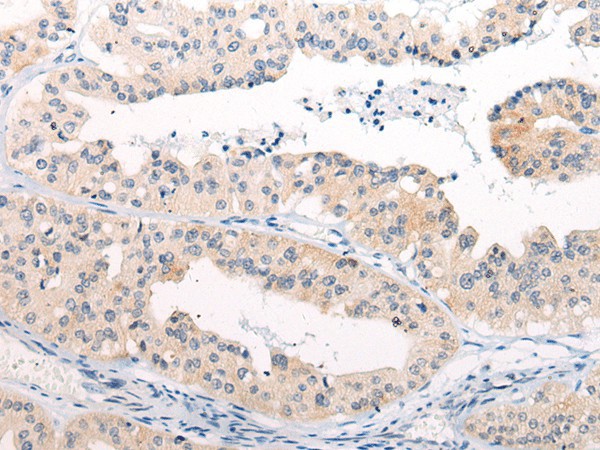 Immunohistochemistry of paraffin-embedded Human liver cancer tissue  using ANAPC15 Polyclonal Antibody at dilution of 1:50(?200)