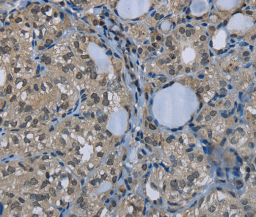 Immunohistochemistry of paraffin-embedded Human thyroid cancer using GYS1 Polyclonal Antibody at dilution of 1:50