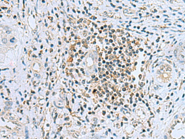 Immunohistochemistry of paraffin-embedded Human liver cancer tissue  using DHRS7B Polyclonal Antibody at dilution of 1:80(?200)