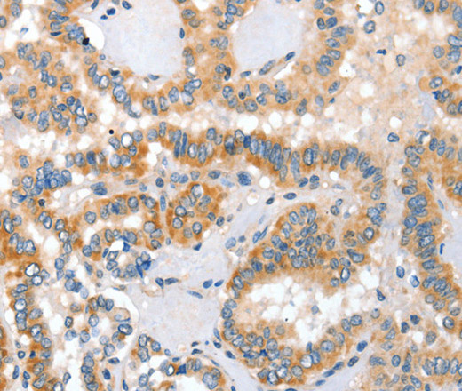 Immunohistochemistry of paraffin-embedded Human thyroid cancer using Placental Alkaline Phosphatase Polyclonal Antibody at dilution of 1:60