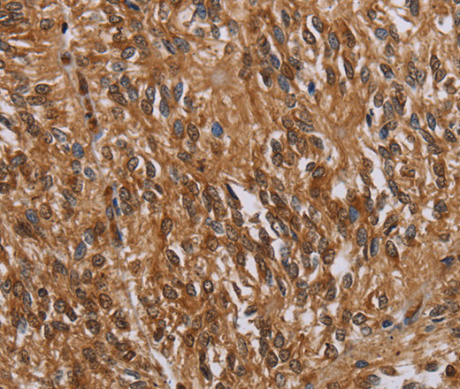 Immunohistochemistry of paraffin-embedded Human ovarian cancer tissue using KARS Polyclonal Antibody at dilution 1:30