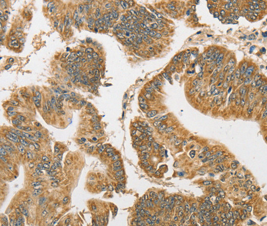 Immunohistochemistry of paraffin-embedded Human colon cancer tissue using ATG3 Polyclonal Antibody at dilution 1:40