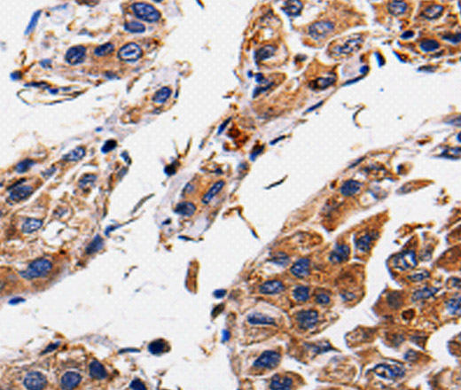 Immunohistochemistry of paraffin-embedded Human gasrtic cancer tissue using RAB41 Polyclonal Antibody at dilution 1:60