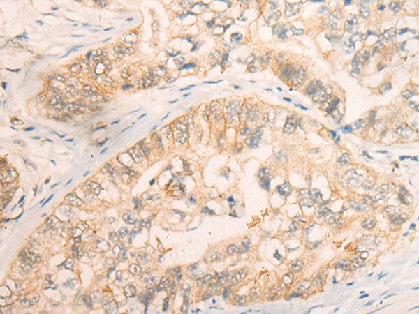 Immunohistochemistry of paraffin-embedded Human gastric cancer tissue  using CD86 Polyclonal Antibody at dilution of 1:30(?200)