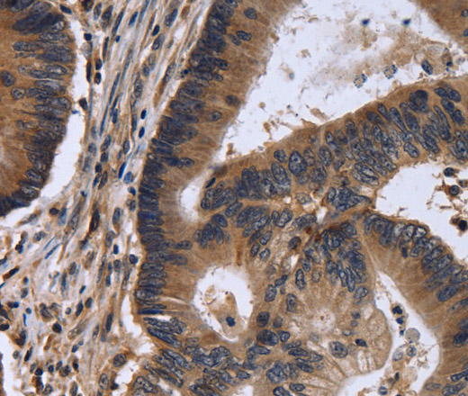 Immunohistochemistry of paraffin-embedded Human colon cancer tissue using FSTL1 Polyclonal Antibody at dilution 1:30