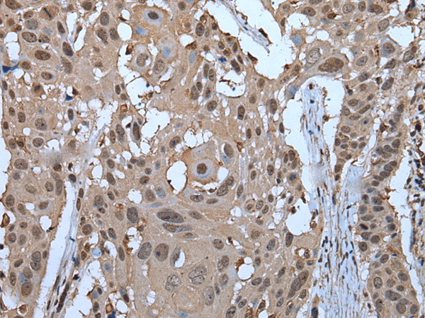 Immunohistochemistry of paraffin-embedded Human esophagus cancer tissue  using ZNF787 Polyclonal Antibody at dilution of 1:45(?200)