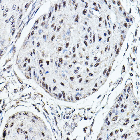 Immunohistochemistry of paraffin-embedded human esophageal cancer using MDC1 Polyclonal Antibody at dilution of 1:100 (40x lens).Perform high pressure antigen retrieval with 10 mM citrate buffer pH 6.0 before commencing with IHC staining protocol.