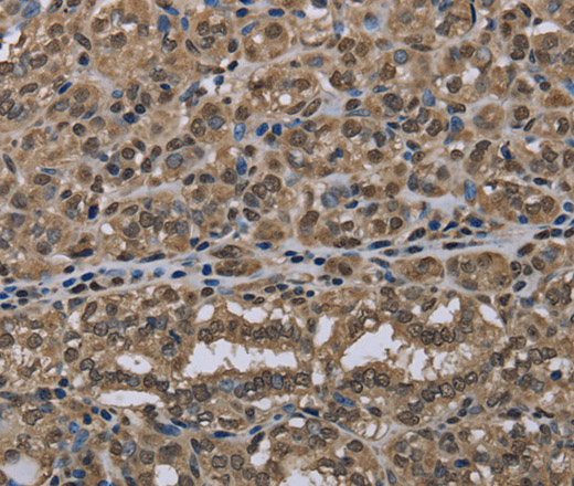 Immunohistochemistry of paraffin-embedded Human thyroid cancer tissue using NLRP6 Polyclonal Antibody at dilution 1:50