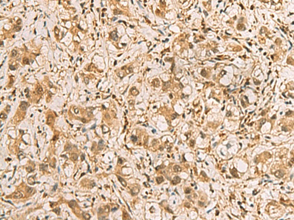 Immunohistochemistry of paraffin-embedded Human liver cancer tissue  using PDXK Polyclonal Antibody at dilution of 1:75(?200)