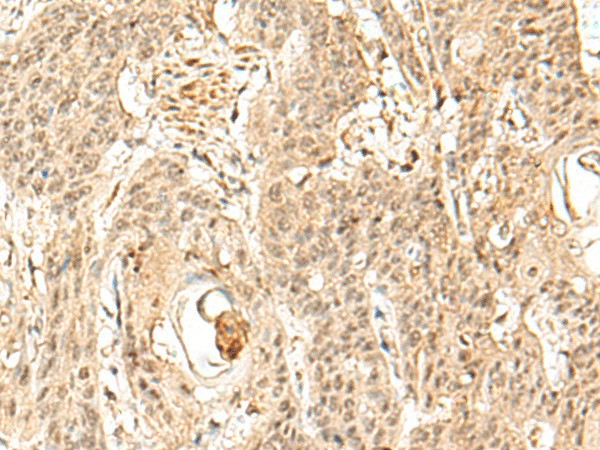 Immunohistochemistry of paraffin-embedded Human esophagus cancer tissue  using SNAPC5 Polyclonal Antibody at dilution of 1:30(?200)