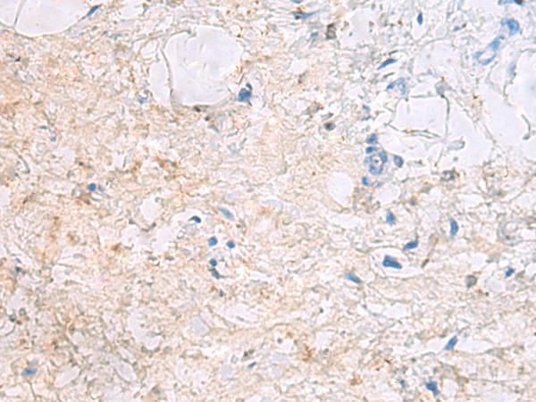 Immunohistochemistry of paraffin-embedded Human gastric cancer tissue  using DPCD Polyclonal Antibody at dilution of 1:50(?200)