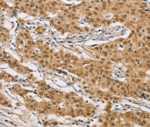 Immunohistochemistry of paraffin-embedded Human gastic cancer using ARHGAP25 Polyclonal Antibody at dilution of 1:40