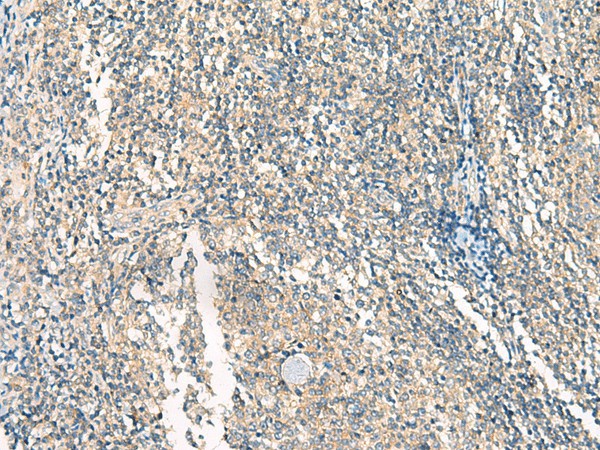 Immunohistochemistry of paraffin-embedded Human tonsil tissue  using HASPIN Polyclonal Antibody at dilution of 1:45(?200)