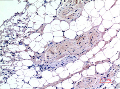 Immunohistochemistry of paraffin-embedded Human liver carcinoma tissue using Smad3 Monoclonal Antibody at dilution of 1:200.