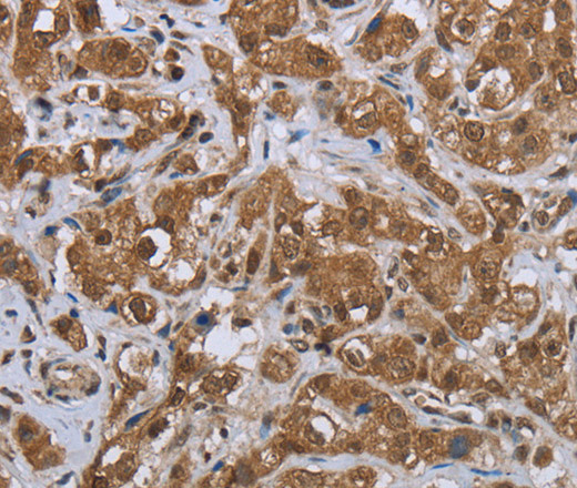 Immunohistochemistry of paraffin-embedded Human breast cancer tissue using GABRB1 Polyclonal Antibody at dilution 1:50