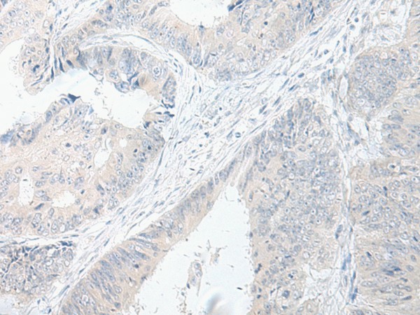 Immunohistochemistry of paraffin-embedded Human colorectal cancer tissue  using GPRASP2 Polyclonal Antibody at dilution of 1:75(?200)