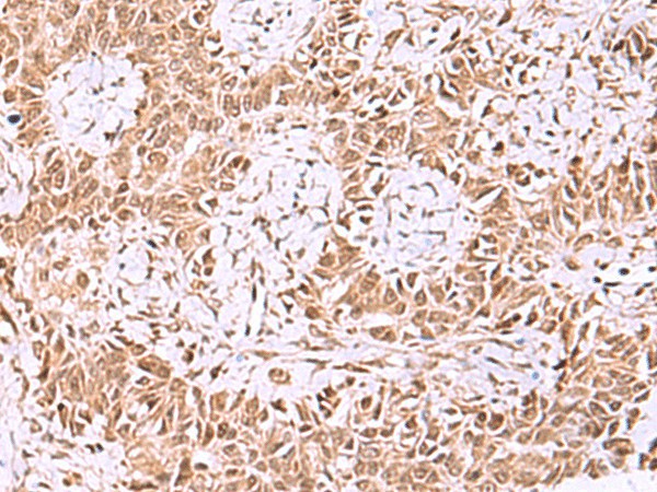 Immunohistochemistry of paraffin-embedded Human ovarian cancer tissue  using IRX1 Polyclonal Antibody at dilution of 1:35(?200)