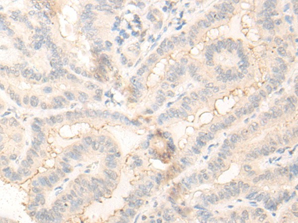 Immunohistochemistry of paraffin-embedded Human thyroid cancer tissue  using RADIL Polyclonal Antibody at dilution of 1:30(?200)