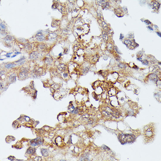 Immunohistochemistry of paraffin-embedded human lung cancer using MAP3K4 Polyclonal Antibody at dilution of 1:100 (40x lens).Perform microwave antigen retrieval with 10 mM PBS buffer pH 7.2 before commencing with IHC staining protocol.