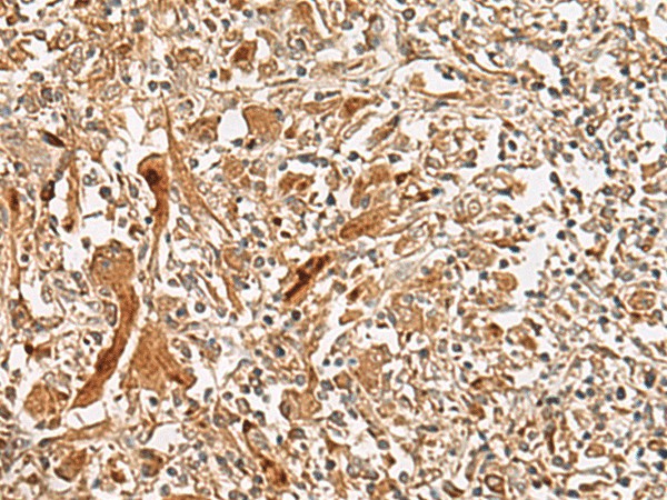 Immunohistochemistry of paraffin-embedded Human liver cancer tissue  using GCC2 Polyclonal Antibody at dilution of 1:45(?200)