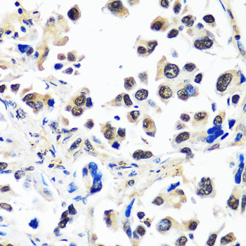 Immunohistochemistry of paraffin-embedded Human lung cancer using CAND1 Polyclonal Antibody at dilution of  1:100 (40x lens).