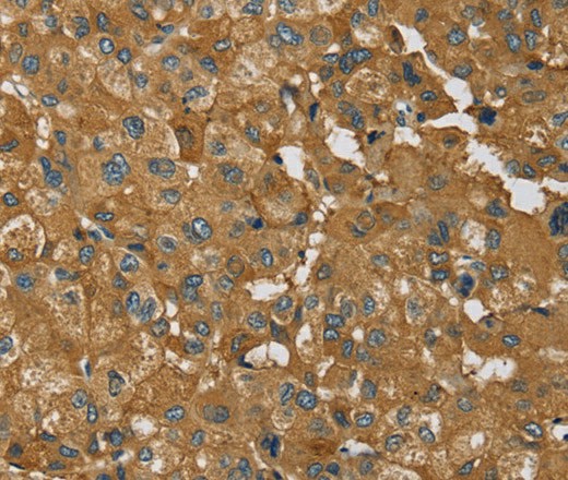 Immunohistochemistry of paraffin-embedded Human liver cancer using RNF5 Polyclonal Antibody at dilution of 1:35