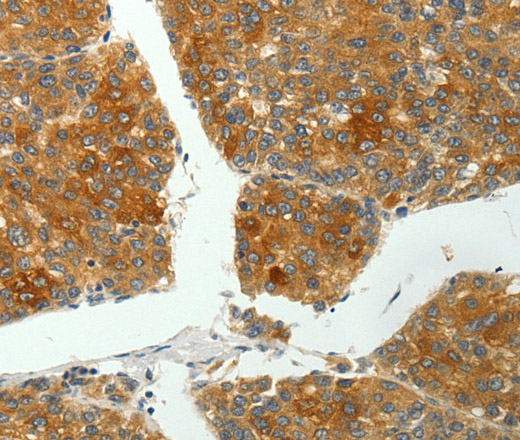 Immunohistochemistry of paraffin-embedded Human liver cancer using SH-PTP1 Polyclonal Antibody at dilution of 1:35