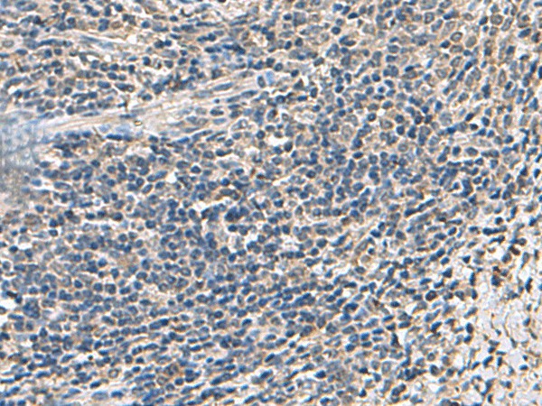 Immunohistochemistry of paraffin-embedded Human cervical cancer tissue  using ATP5F1D Polyclonal Antibody at dilution of 1:55(?200)