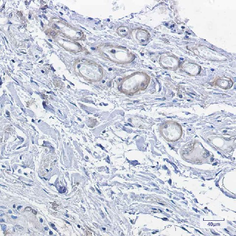 Immunohistochemistry of cAMP Protein Kinase Catalytic subunit  in paraffin-embedded Human colon cancer tissue using cAMP Protein Kinase Catalytic subunit  Rabbit mAb at dilution 1:100