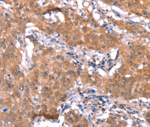 Immunohistochemistry of paraffin-embedded Human gastric cancer tissue using FAM13B Polyclonal Antibody at dilution 1:30