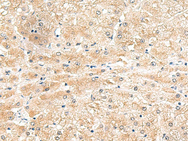 Immunohistochemistry of paraffin-embedded Human liver cancer tissue  using LRG1 Polyclonal Antibody at dilution of 1:50(?200)