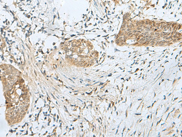 Immunohistochemistry of paraffin-embedded Human esophagus cancer tissue  using SNRPD1 Polyclonal Antibody at dilution of 1:70(?200)