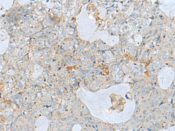 Immunohistochemistry of paraffin-embedded Human ovarian cancer tissue  using NAGK Polyclonal Antibody at dilution of 1:35(?200)