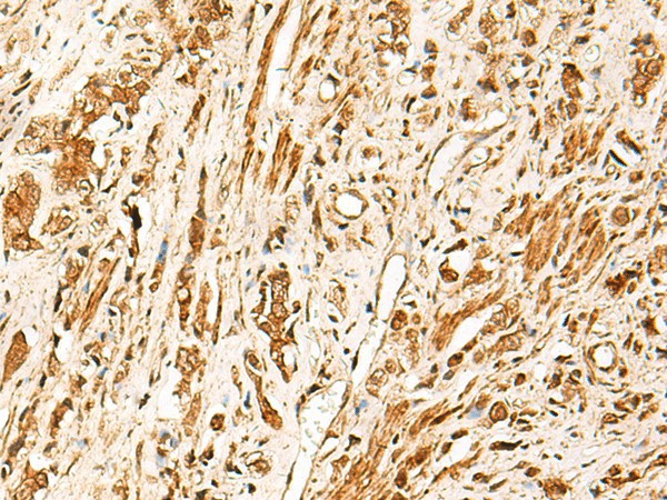 Immunohistochemistry of paraffin-embedded Human prost ate cancer tissue  using TCF7 Polyclonal Antibody at dilution of 1:30(?200)