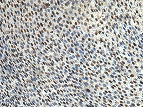 Immunohistochemistry of paraffin-embedded Human lung cancer tissue  using DDX39A Polyclonal Antibody at dilution of 1:65(?200)