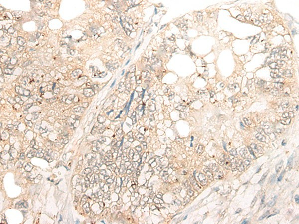 Immunohistochemistry of paraffin-embedded Human gastric cancer tissue  using DCP2 Polyclonal Antibody at dilution of 1:45(?200)