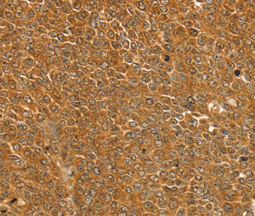 Immunohistochemistry of paraffin-embedded Human ovarian cancer tissue using ST18 Polyclonal Antibody at dilution 1:50