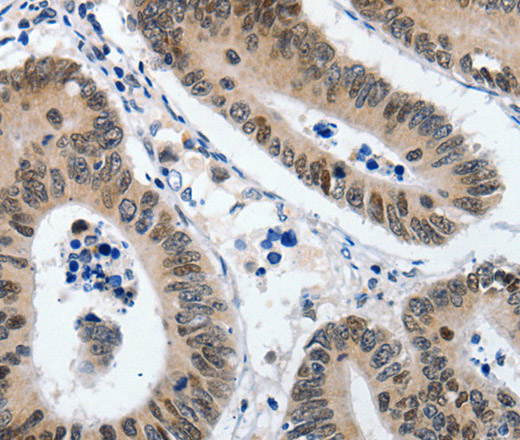 Immunohistochemistry of paraffin-embedded Human colon cancer using KLF5 Polyclonal Antibody at dilution of 1:120