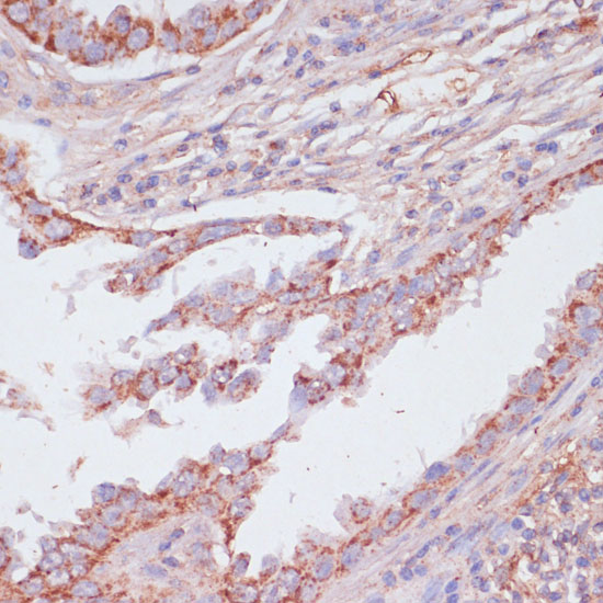 Immunohistochemistry of paraffin-embedded Human lung cancer using ATP5C1 Polyclonal Antibody at dilution of  1:100 (40x lens).