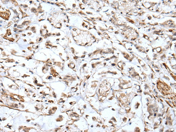 Immunohistochemistry of paraffin-embedded Human gastric cancer tissue  using HSPB1 Polyclonal Antibody at dilution of 1:25(?200)