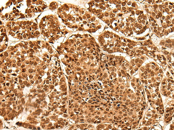 Immunohistochemistry of paraffin-embedded Human esophagus cancer tissue  using NEK7 Polyclonal Antibody at dilution of 1:60(?200)