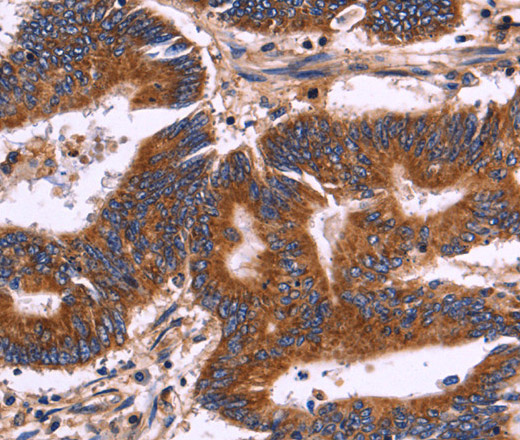 Immunohistochemistry of paraffin-embedded Human colon cancer tissue using KIR2DL1/3/4/S4 Polyclonal Antibody at dilution 1:30