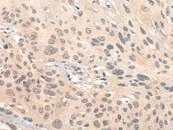 Immunohistochemistry of paraffin-embedded Human esophagus cancer tissue  using HIPK2 Polyclonal Antibody at dilution of 1:65(?200)