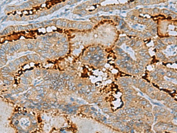 Immunohistochemistry of paraffin-embedded Human thyroid cancer tissue  using ENKD1 Polyclonal Antibody at dilution of 1:75(?200)