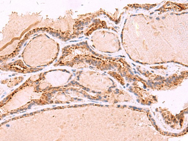 Immunohistochemistry of paraffin-embedded Human thyroid cancer tissue  using RABEPK Polyclonal Antibody at dilution of 1:65(?200)