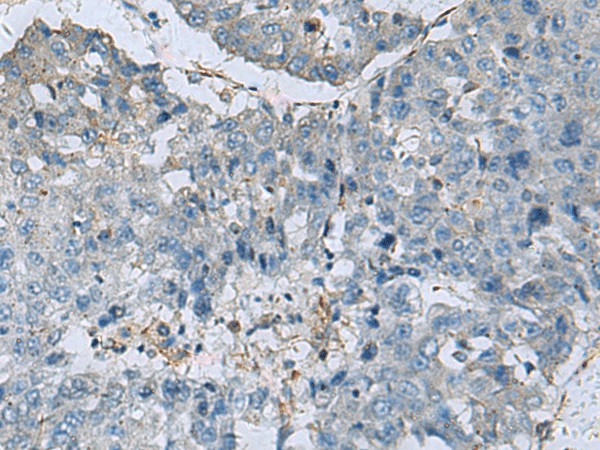 Immunohistochemistry of paraffin-embedded Human liver cancer tissue  using GLS Polyclonal Antibody at dilution of 1:70(?200)