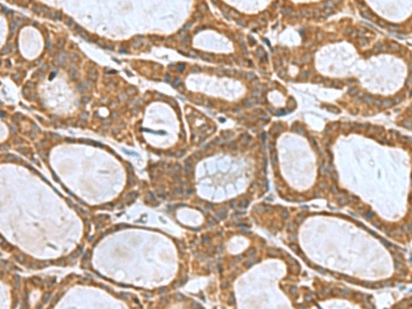 Immunohistochemistry of paraffin-embedded Human thyroid cancer tissue  using KIF2A Polyclonal Antibody at dilution of 1:55(?200)