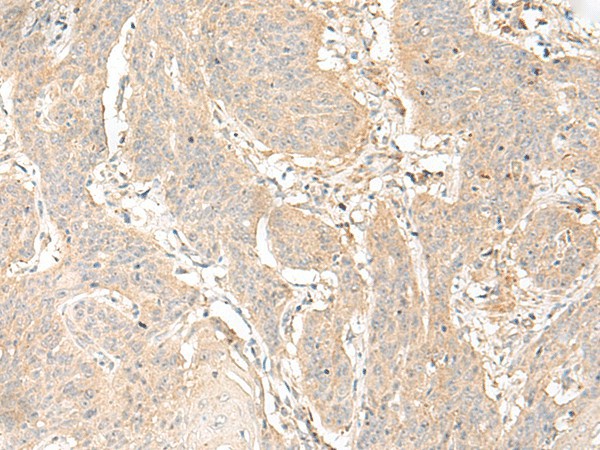 Immunohistochemistry of paraffin-embedded Human esophagus cancer tissue  using GLIS1 Polyclonal Antibody at dilution of 1:40(?200)