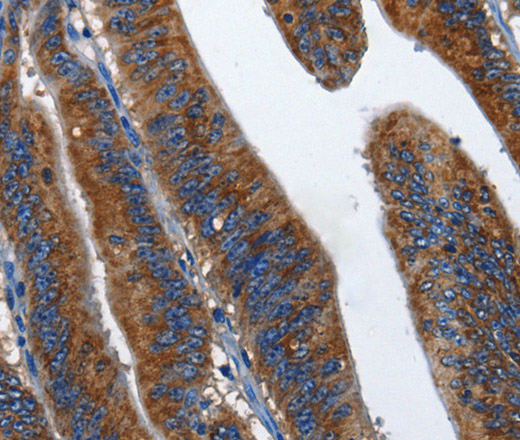 Immunohistochemistry of paraffin-embedded Human colon cancer using CD27 Polyclonal Antibody at dilution of 1:60