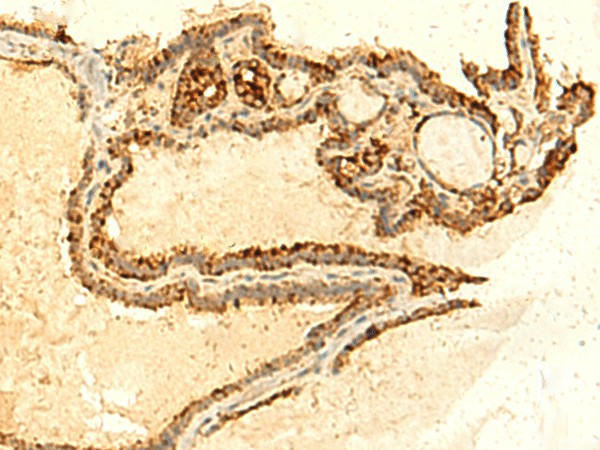 Immunohistochemistry of paraffin-embedded Human thyroid cancer tissue  using UNKL Polyclonal Antibody at dilution of 1:50(?200)